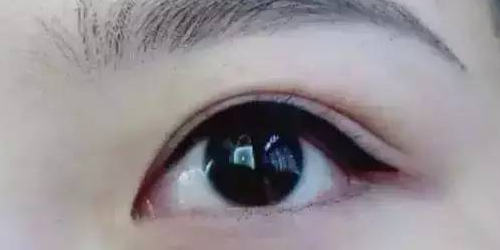 纳米无痕双眼皮的好处