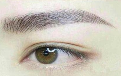 上海双眼皮手术修复价格