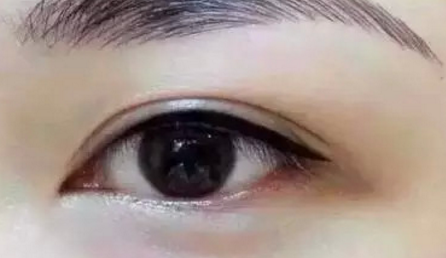 割双眼皮和开眼角多久能恢复