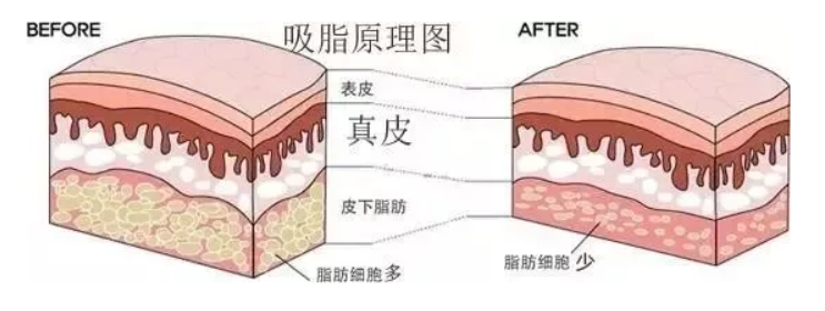 吸脂后皮肤会松吗