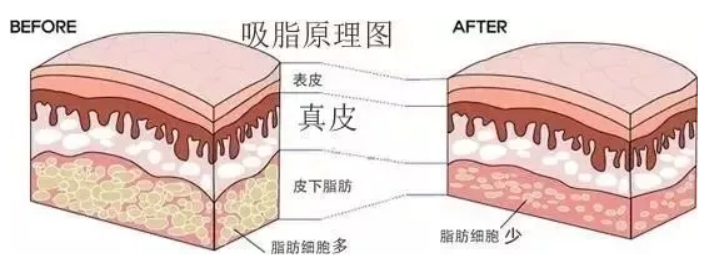 全身抽脂后皮肤松弛怎么办