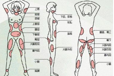 抽80斤脂肪多少钱
