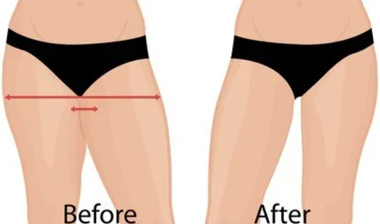 腰腹吸脂后多久可以吸大腿
