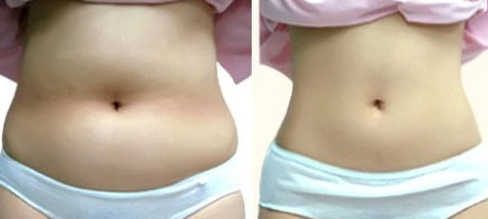 吸脂有什么副作用