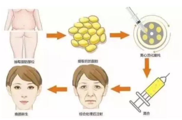 吸脂和填充能不能一起做