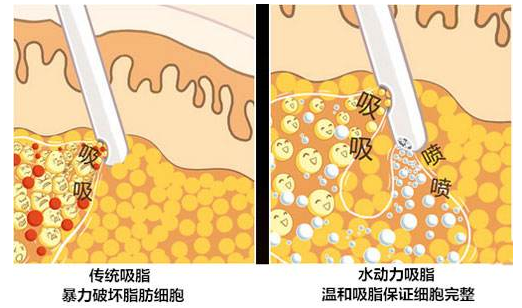 吸脂和抽脂有什么区别