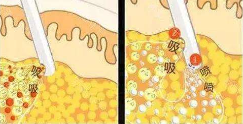 吸脂手术价格是多少很贵吗
