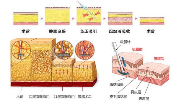 吸脂后皮肤凹凸不平怎么办？