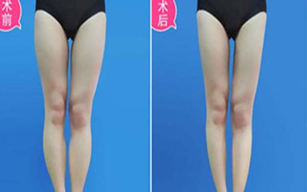 腿部吸脂效果前后对比图
