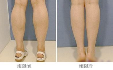 吸脂减肥前后