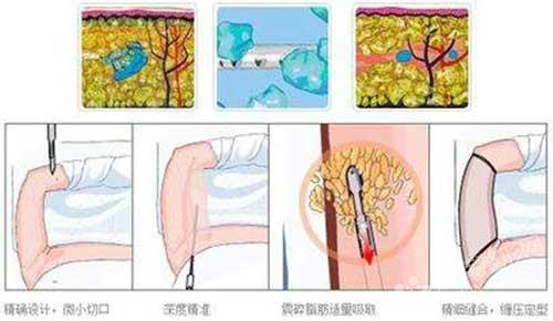 吸脂后皮肤会不会松弛?
