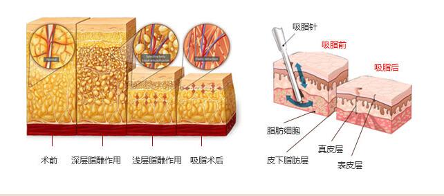 南京腰腹部吸脂效果如何?