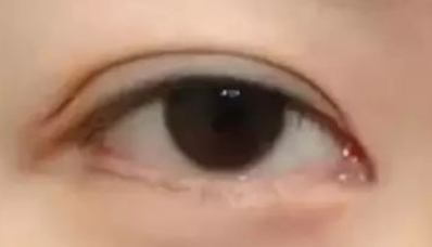 长春哪些医美机构可以做内切去眼袋?