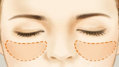 34岁眼袋很严重怎么办