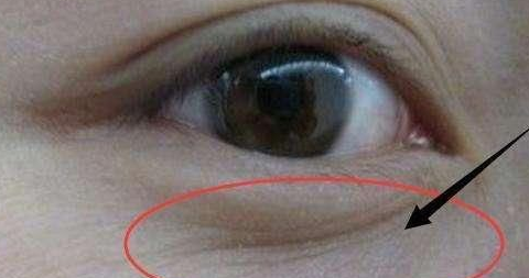 眼袋手术多久不浮肿