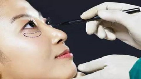 南京溶脂去眼袋哪家整形美容医院效果好？