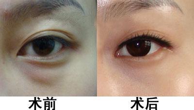 眼袋抽脂痛吗