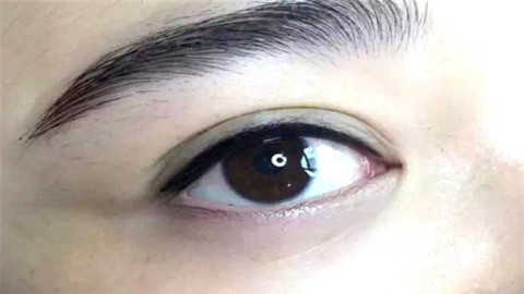 做吸脂去眼袋危险吗
