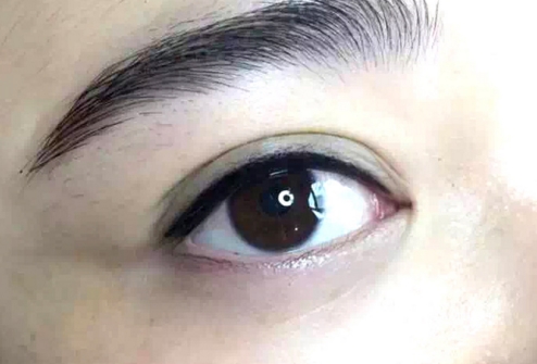 祛眼袋手术会肿吗