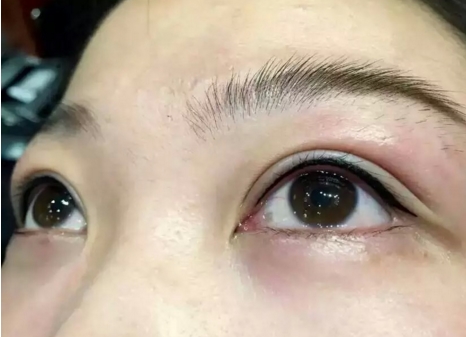 手术去眼袋哪里好