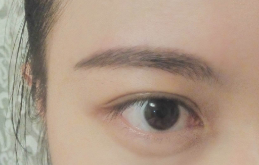 祛除眼袋需要拆线吗