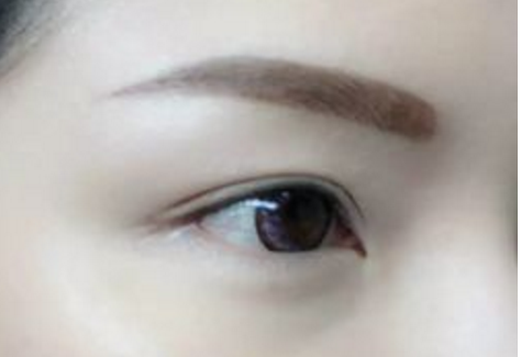 去下眼袋肿吗