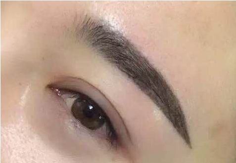 眼袋抽脂多久能好