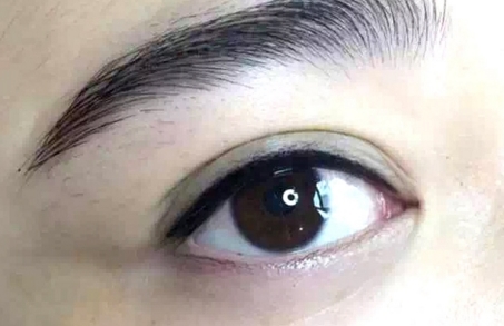 压双眼皮几天能碰水