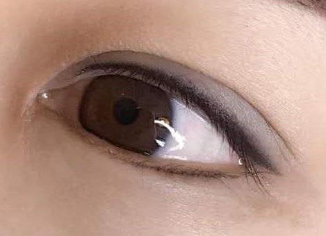 激光去眼袋失败怎么办