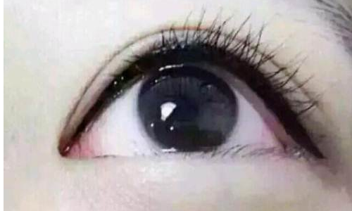 压双眼皮应该注意什么