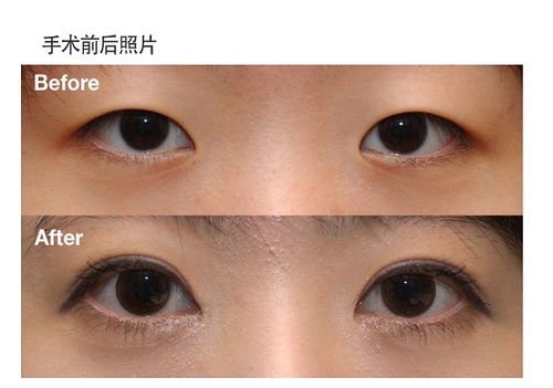开内眼角整形术前后对比图