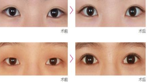 开眼角手术前注意哪些呢