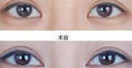 开眼角手术效果好不好
