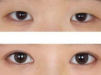 做开眼角手术有哪些安全性