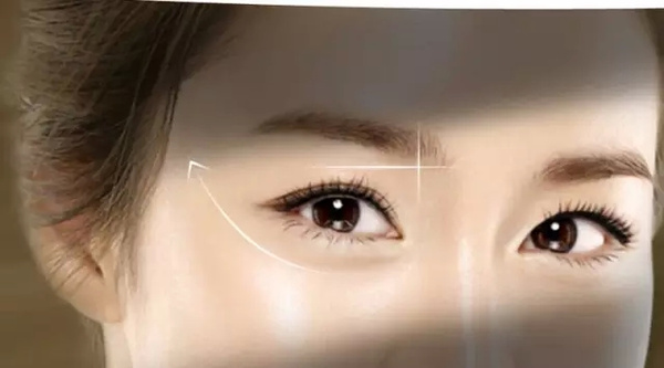 做开眼角手术有没有副作用呢