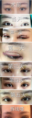 双眼皮怎么拆线过程图
