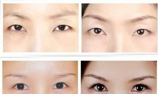 外眦赘皮矫正术多少钱