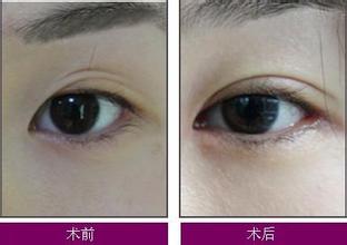 开眼角手术方法优点缺点的比较