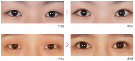 上海做开眼角手术钱多少