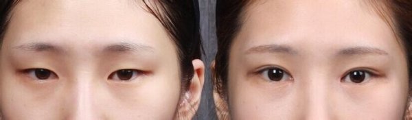 怎样判断开眼角增生了