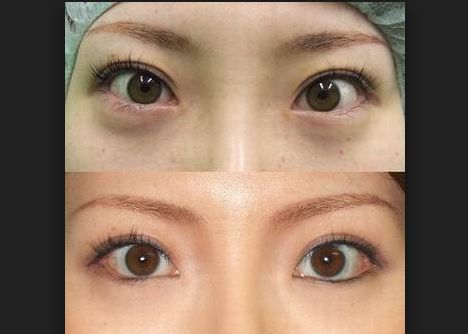 上海开眼角双眼皮价格