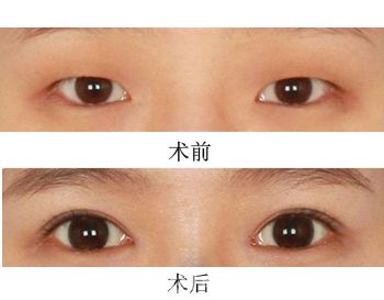 开眼角手术有哪些适应人群呢