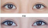 做开眼角术前应该注意哪些