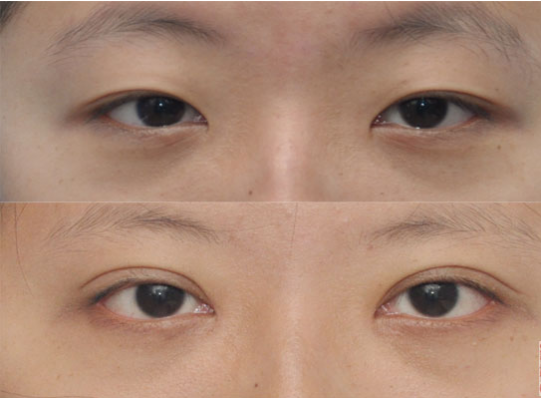 开眼角的风险是什么？