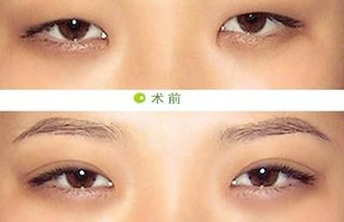 开眼角后会有什么危害