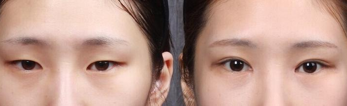 导致开眼角失败有哪些原因