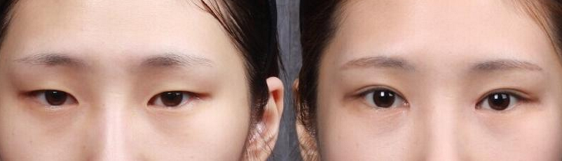 开眼角整形手术能改变眼睛大小吗
