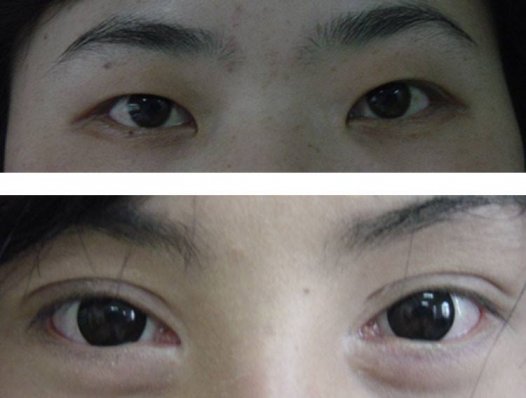 无痕开内眼角术真的无痕吗