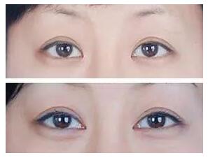 开眼角手术时会不会疼
