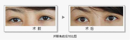 开外眼角术前后要注意哪些